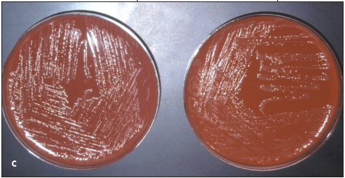Disseminated Gonococcal Infection