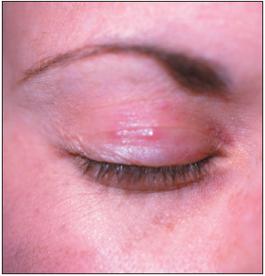 papular on eyelid
