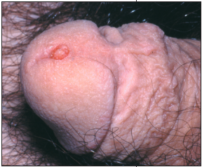 Condyloma Acuminatum