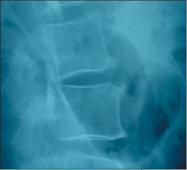 Vertebral Osteomyelitis