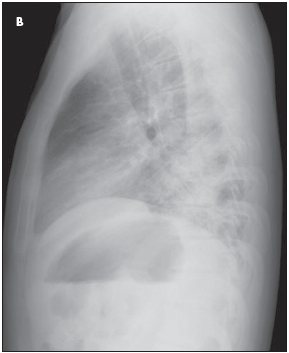 AIDS-Related Kaposi Sarcoma