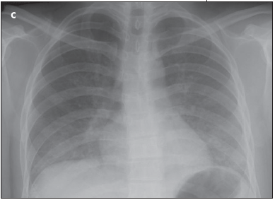 AIDS-Related Kaposi Sarcoma