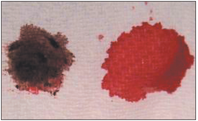 Dapsone-Induced Methemoglobinemia