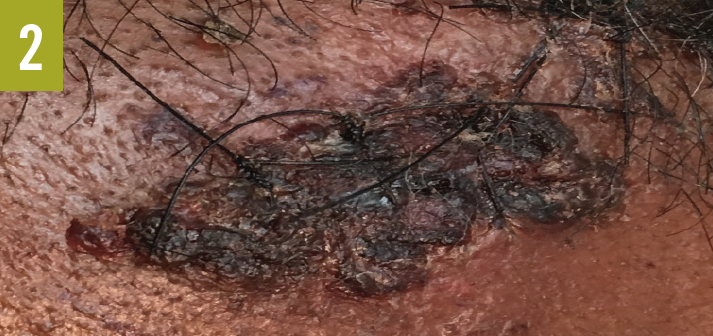 Sweet syndrome caused by AML figure 2