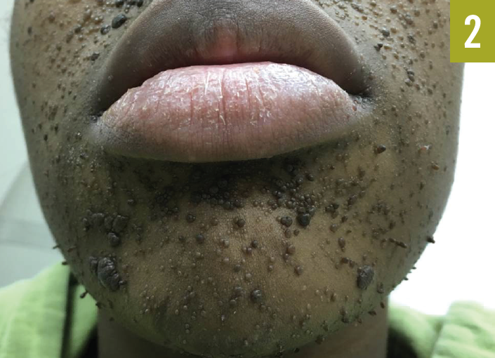 Tuberous Sclerosis Complex Figure 2