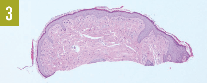 Tuberous Sclerosis Complex Figure 3