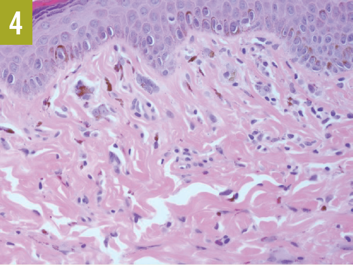Tuberous Sclerosis Complex Figure 4