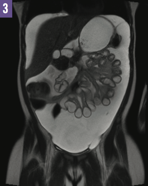 Ventriculoperitoneal Shunt Placement