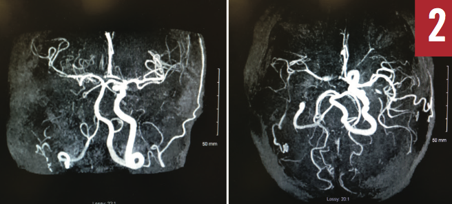 Extracranial and Intracranial Vascular Disease