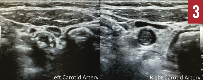 Extracranial and Intracranial Vascular Disease