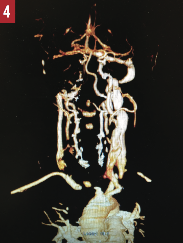 Extracranial and Intracranial Vascular Disease