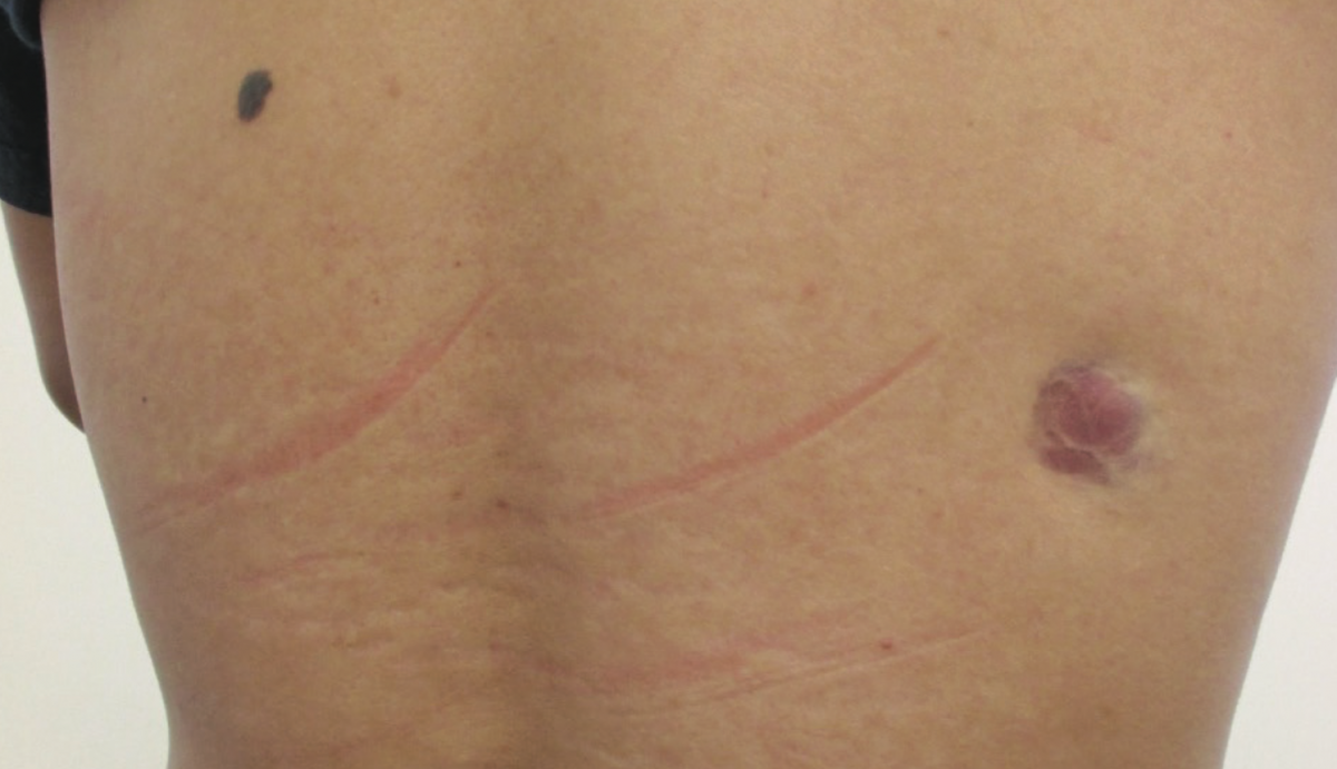 Dermatofibrosarcoma protuberans