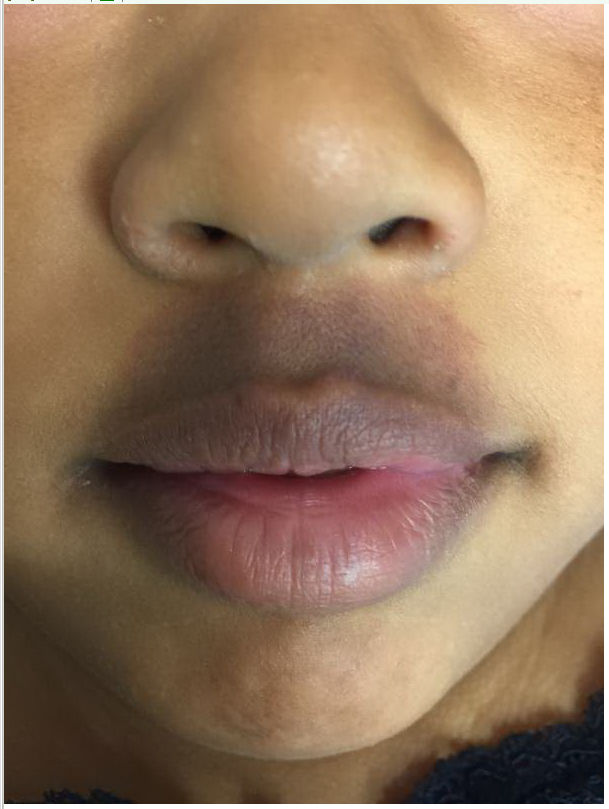 What Caused This 7YearOld Girl’s Facial Bruise? Consultant360