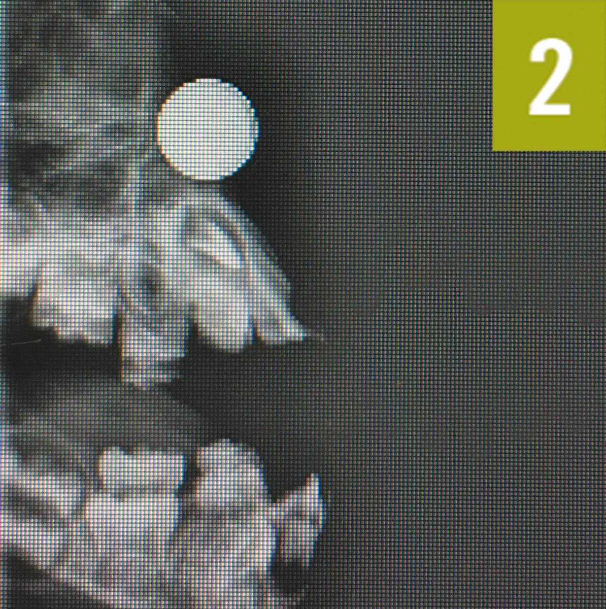 nasal foreign body 2
