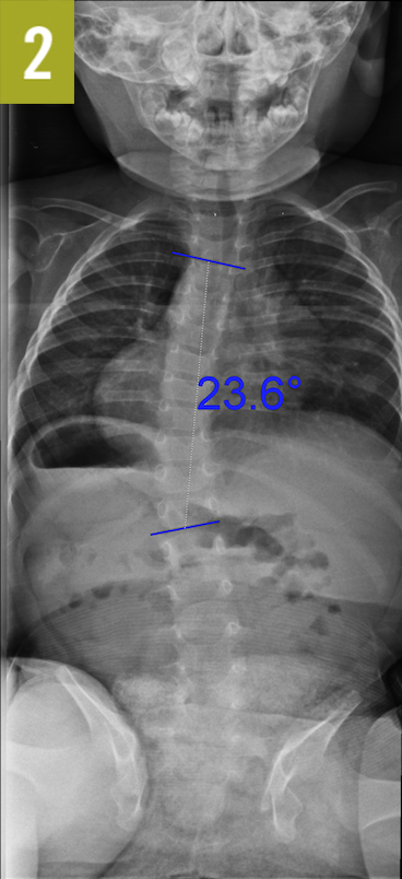 scoliosis figure 2