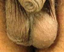 Horizontal lie of right testis