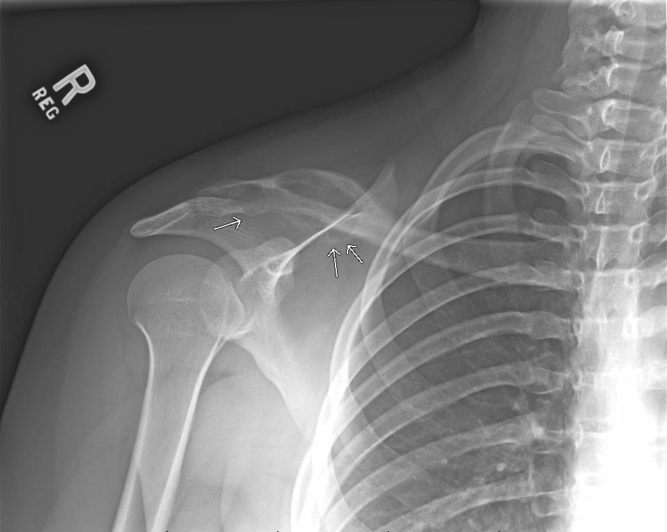 shoulder pain MRI