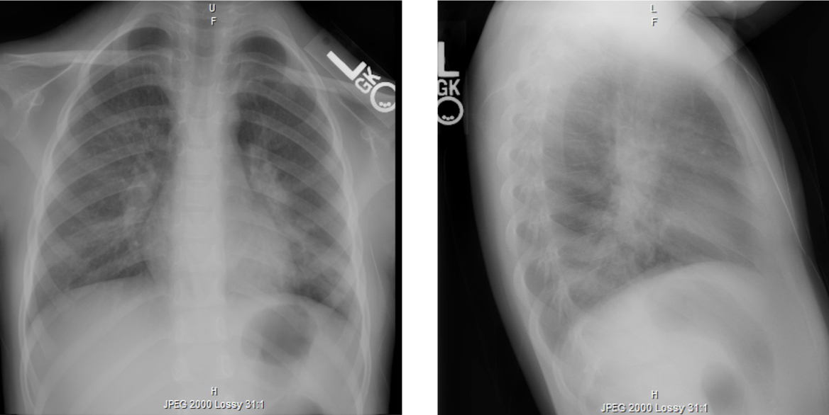 recurrent pneumonia chest scan
