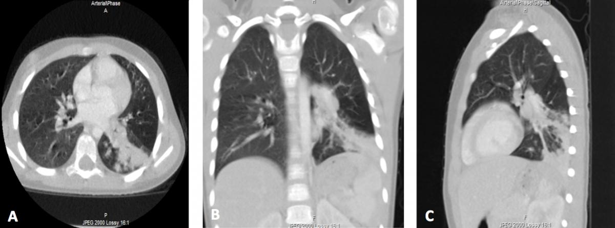 recurrent pneumonia chest xray