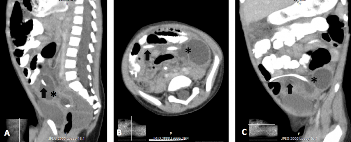 distal VP shunt catheter tip pseudocyst