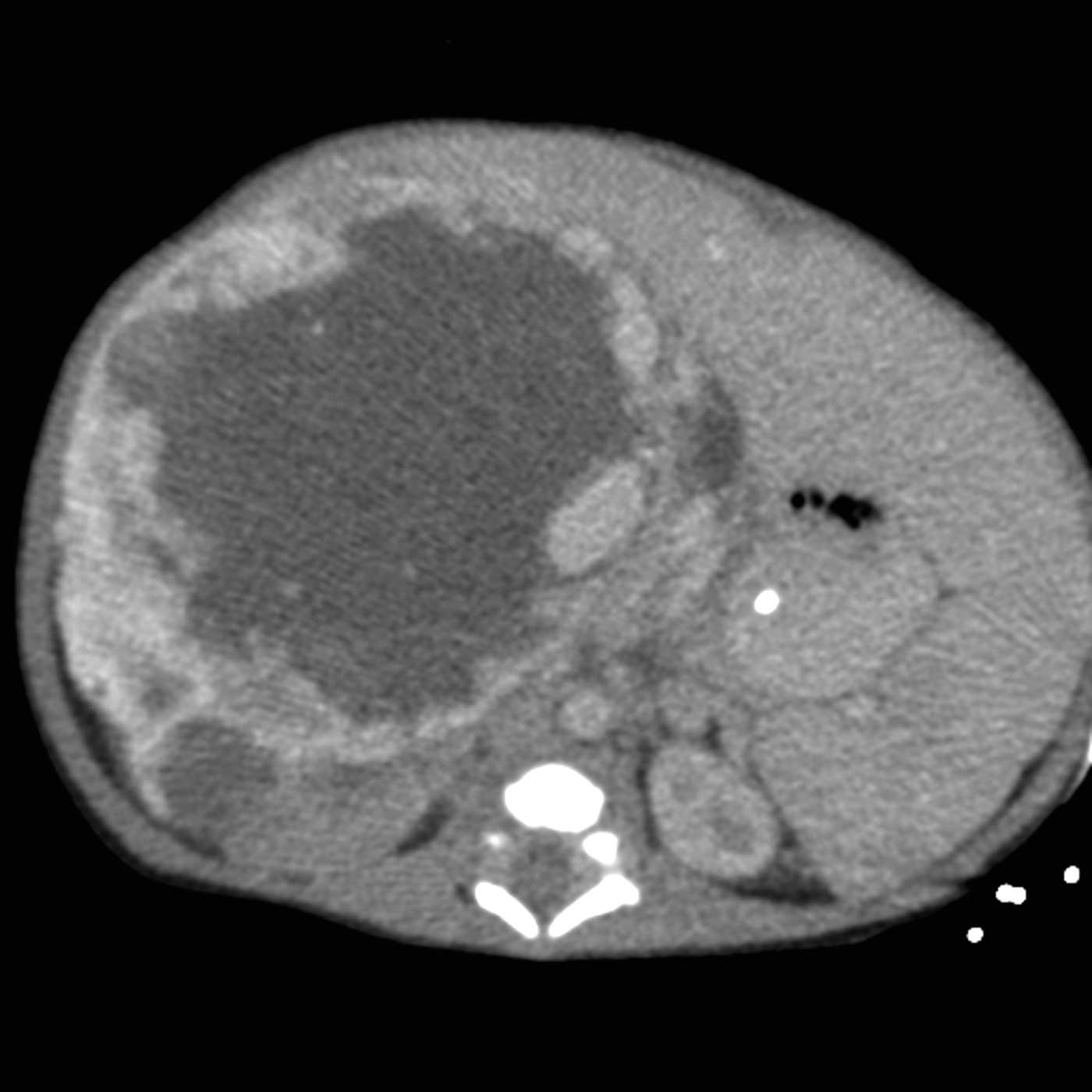 Abdominal CT