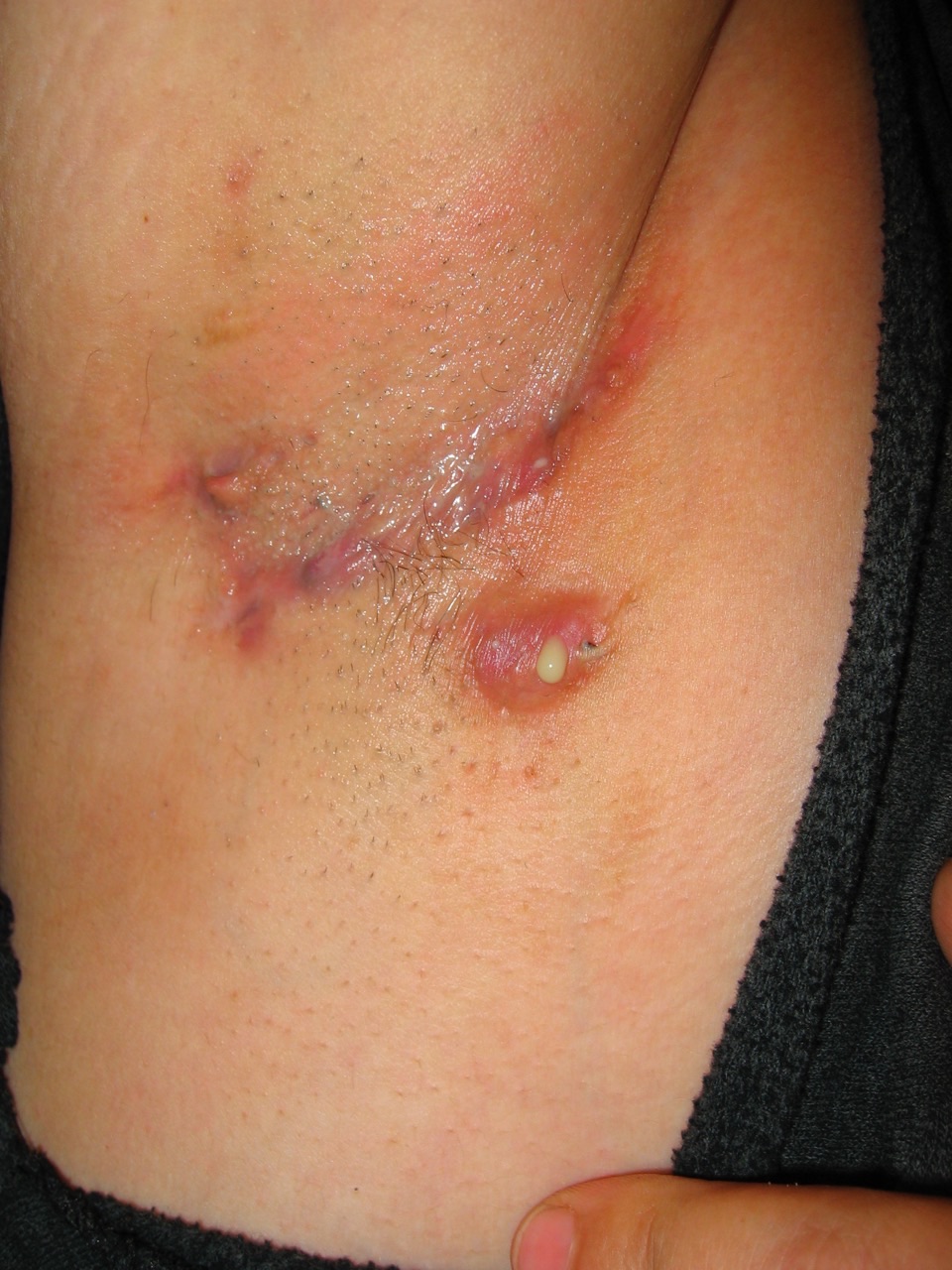 hidradenitis suppurativa
