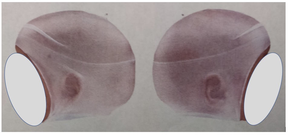 craniosynostosis fig 3