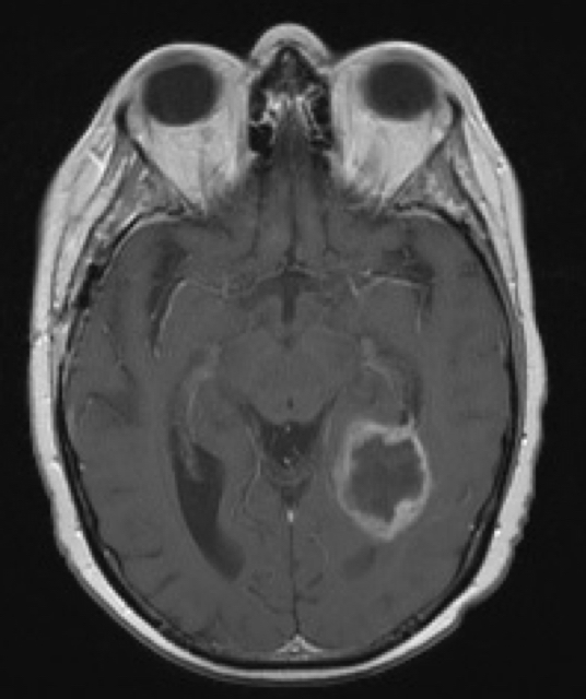glioblastoma figure 5