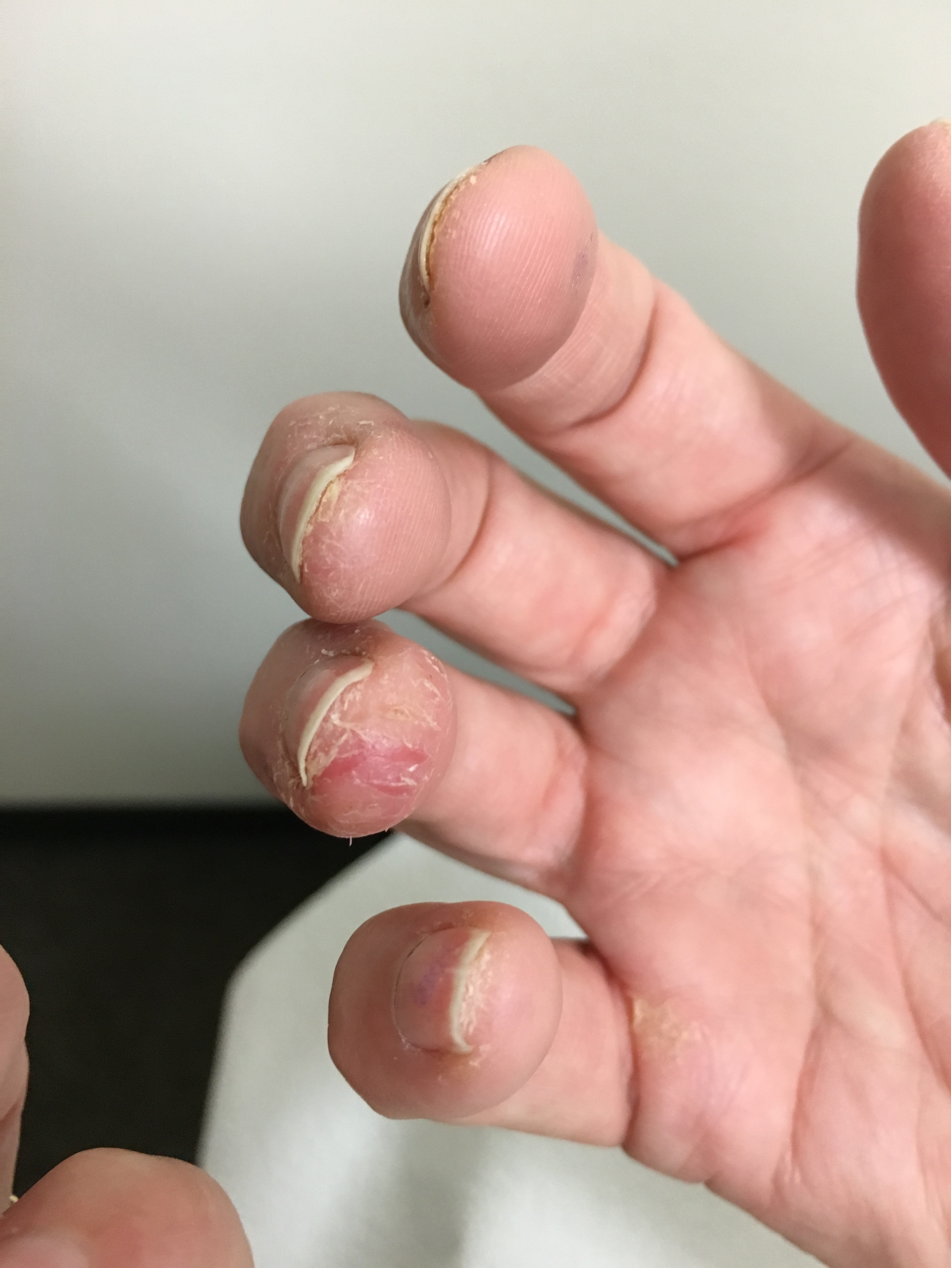 Allergic Contact Dermatitis to Acrylate Chemicals in Artificial Nails