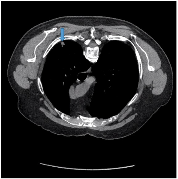 Incidental IllDefined Nodular Lung Opacities Discovered During CT