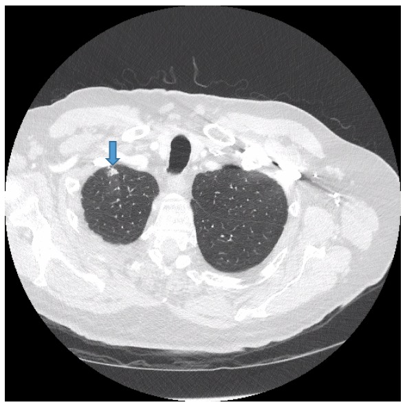 Incidental IllDefined Nodular Lung Opacities Discovered During CT