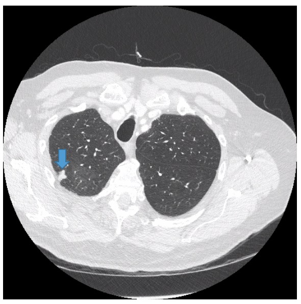 Incidental IllDefined Nodular Lung Opacities Discovered During CT Colonoscopy Consultant360