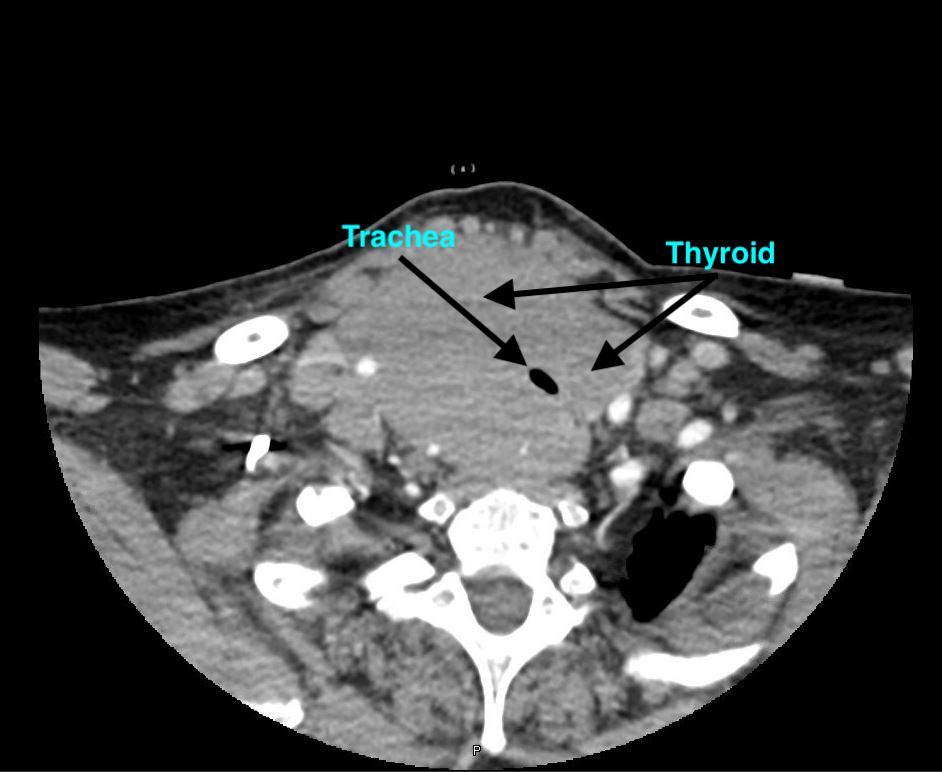 Diffuse Large B Cell Lymphoma Of The Thyroid Consultant360