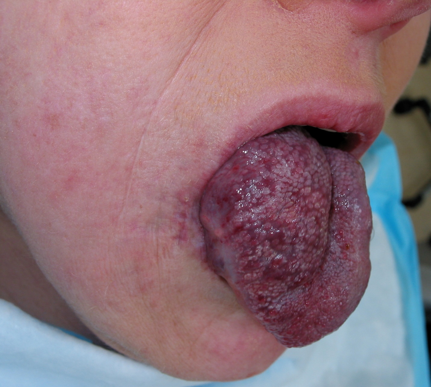 Hemangioma
