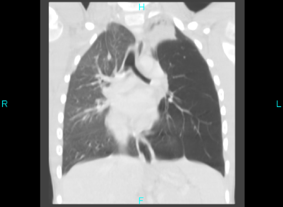 Figure 2. Coronal contrast CT image showing a nodular endobronchial lesion in the left mainstem bronchus with left upper lobe and lingular atelectasis and a hyperinflated left lower lobe. An azygos fissure was noted in the right lung.