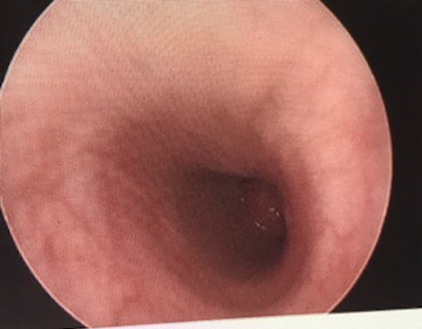 Figure 3. An obstructive endobronchial lesion at the distal entry of the left mainstem bronchus.