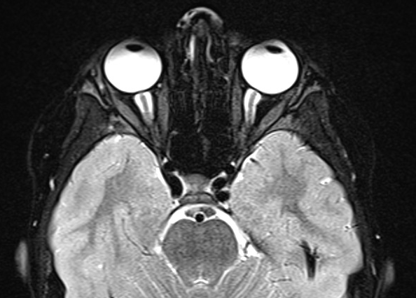Figure 2. T2-weighted fat-saturated MRI, axial view, demonstrating posterior scleral flattening and prominent optic nerve CSF spaces.