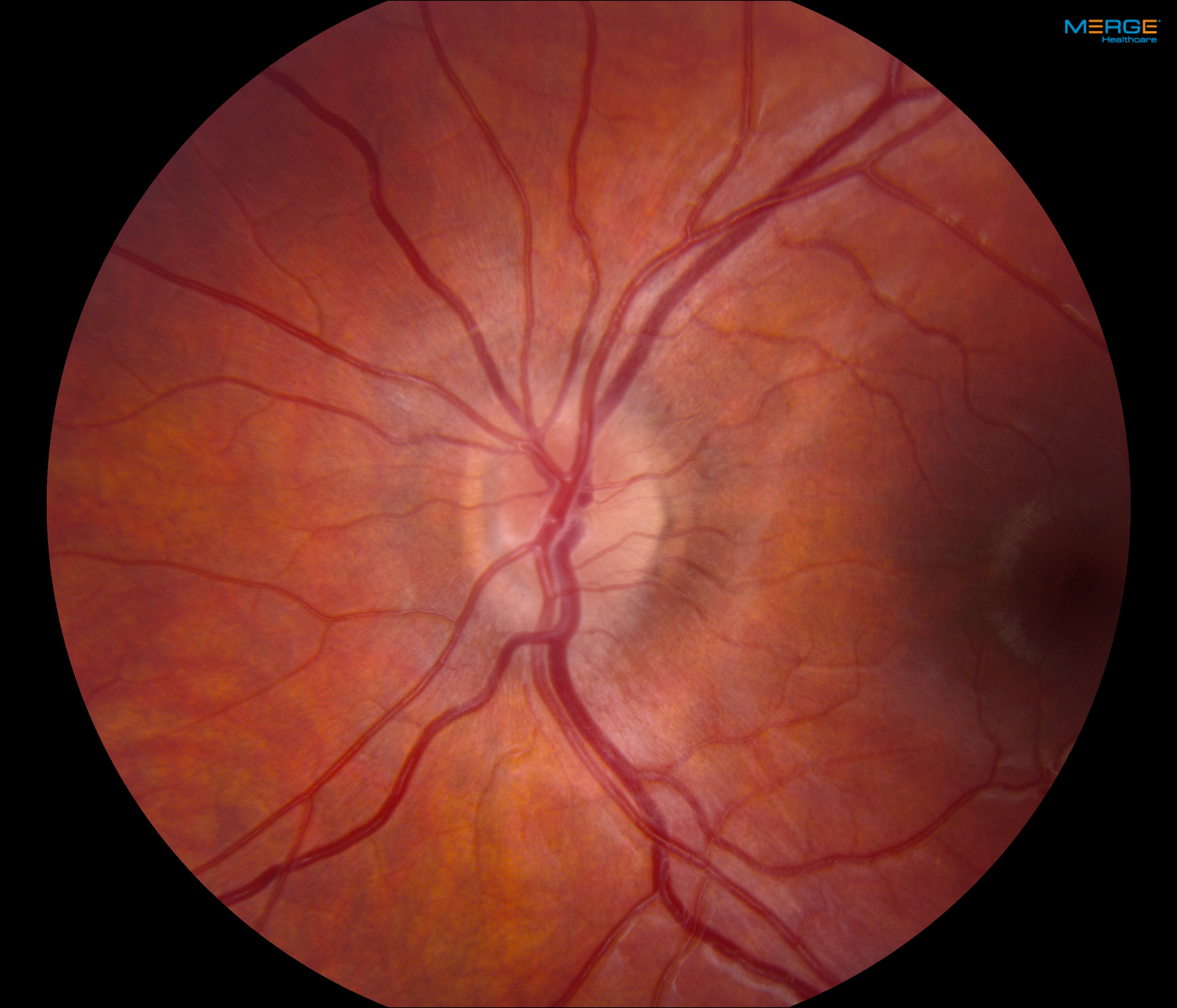 Figure 3 (left). Fundus photographs demonstrating bilateral mild optic nerve head edema.