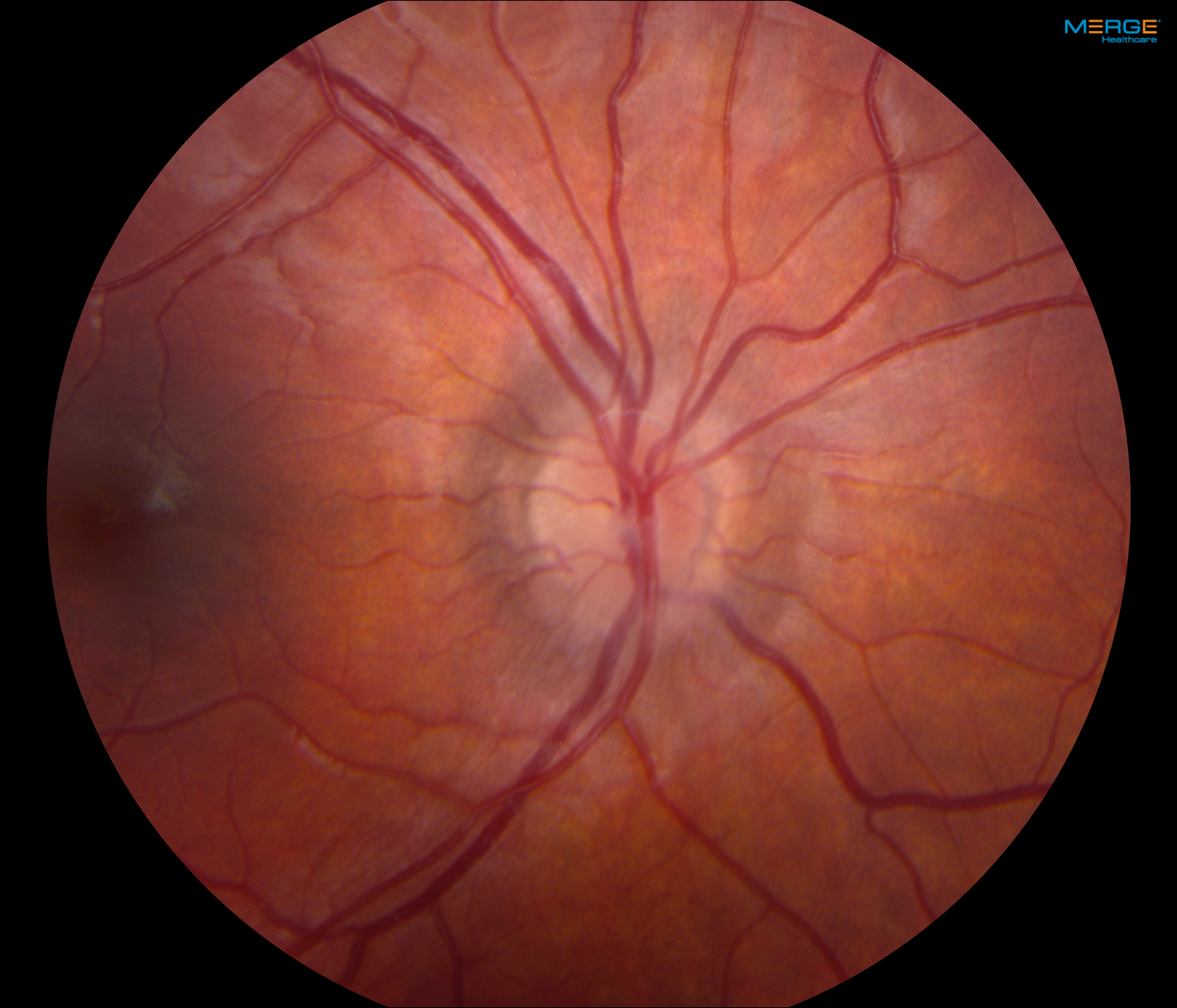 Figure 3 (right). Fundus photographs demonstrating bilateral mild optic nerve head edema.