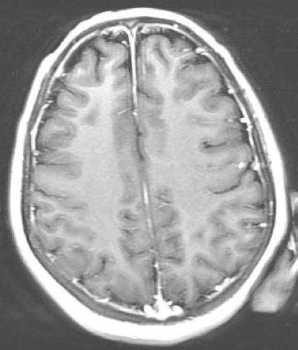 MRI scan of the brain with contrast 