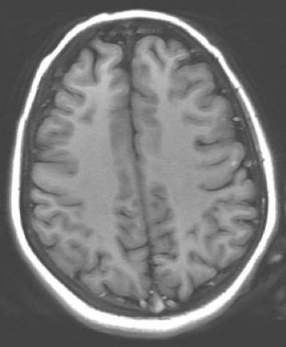 MRI scan of the brain without contrast 