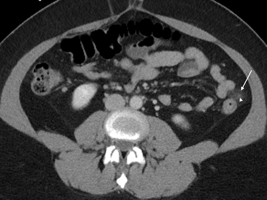 Epiploic Appendagitis An Often Unrecognized Cause Of Abdominal Pain 