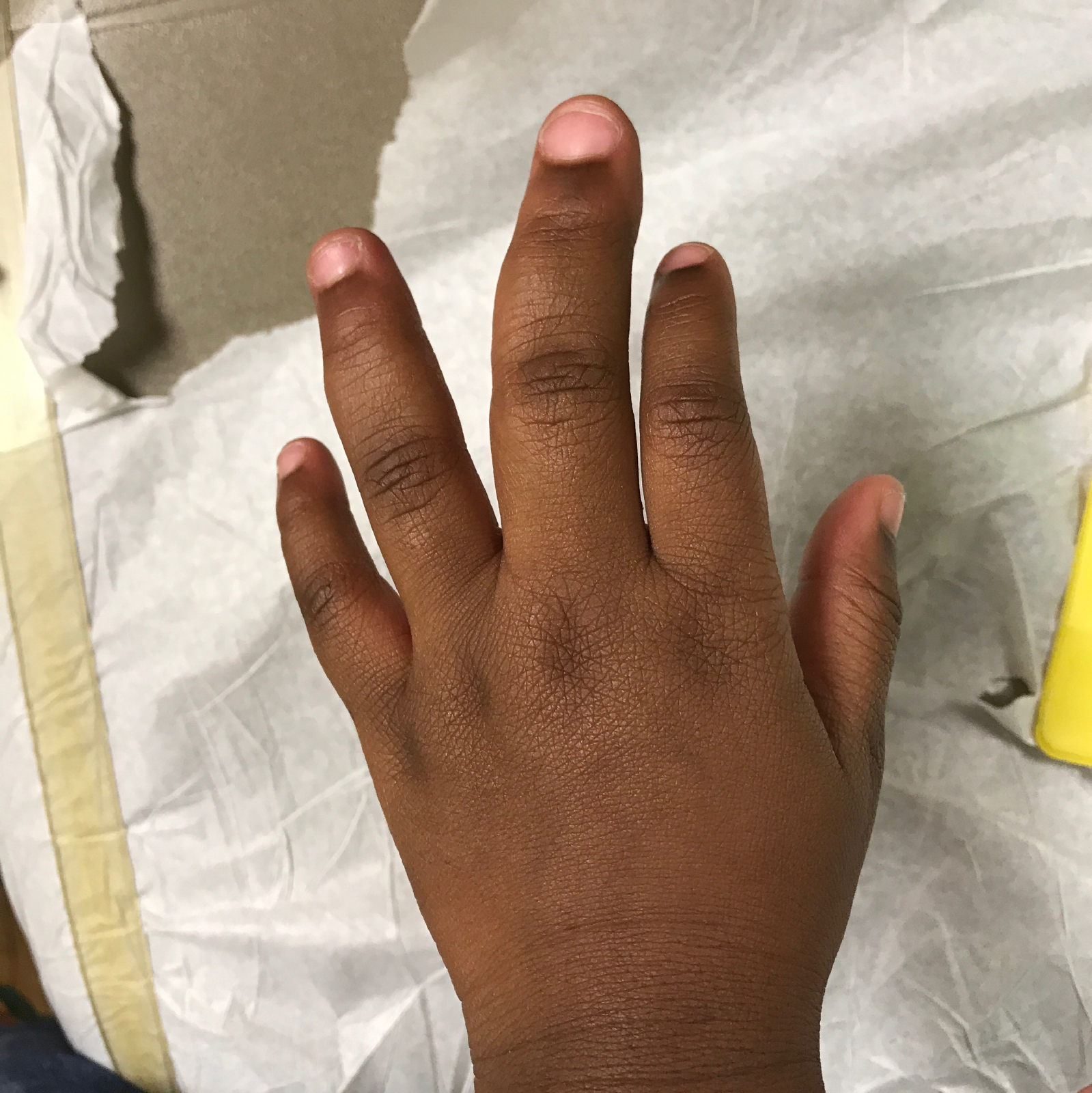 Figure 1. The patient’s enlarged left middle finger at initial presentation.