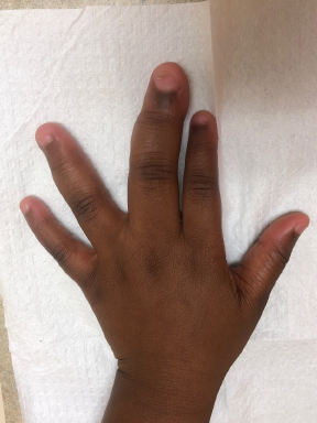 Figure 3. Enlarged left middle and ring fingers at a 1-year follow-up visit.