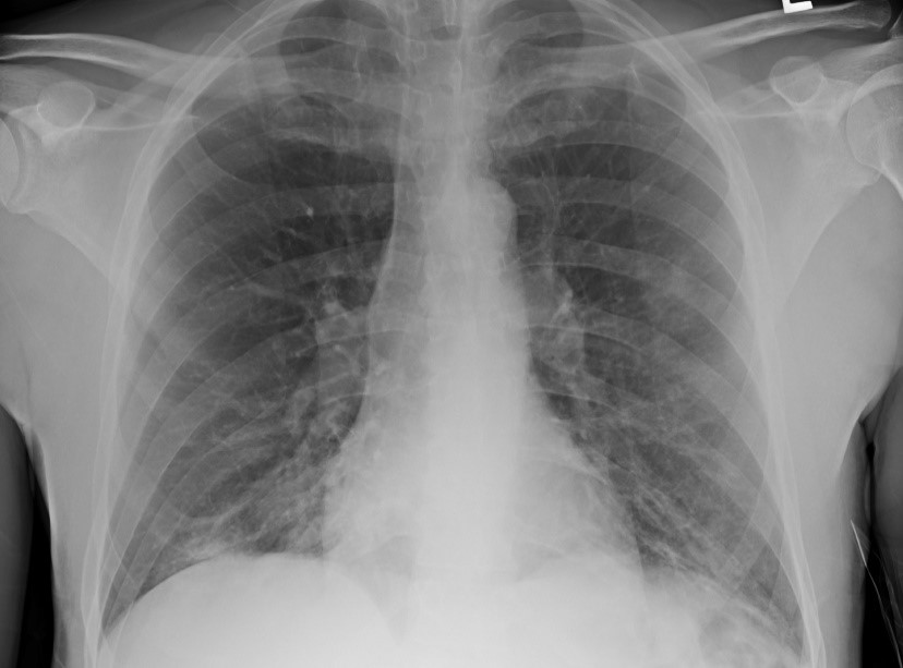 chest radiograph
