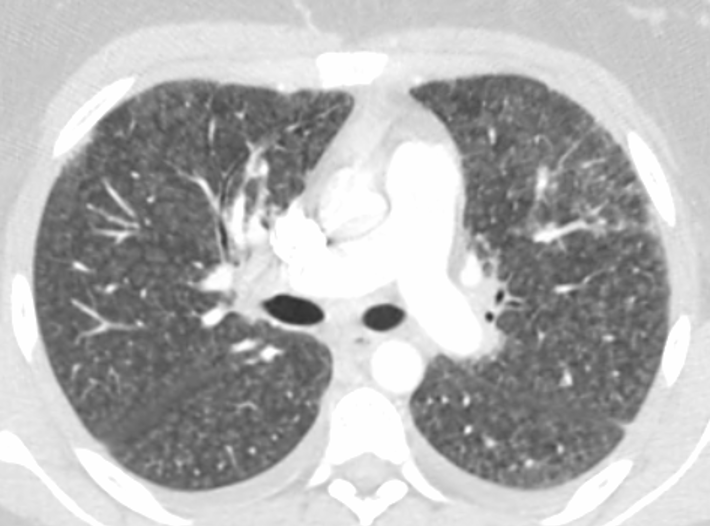 CT of the chest