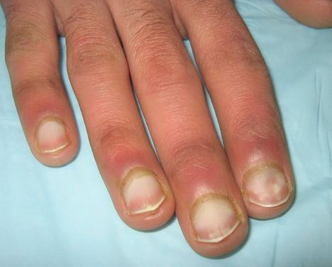 An Atlas Of Nail Disorders Part 9 Consultant360 An Atlas Of Nail Disorders Part 9 Consultant360