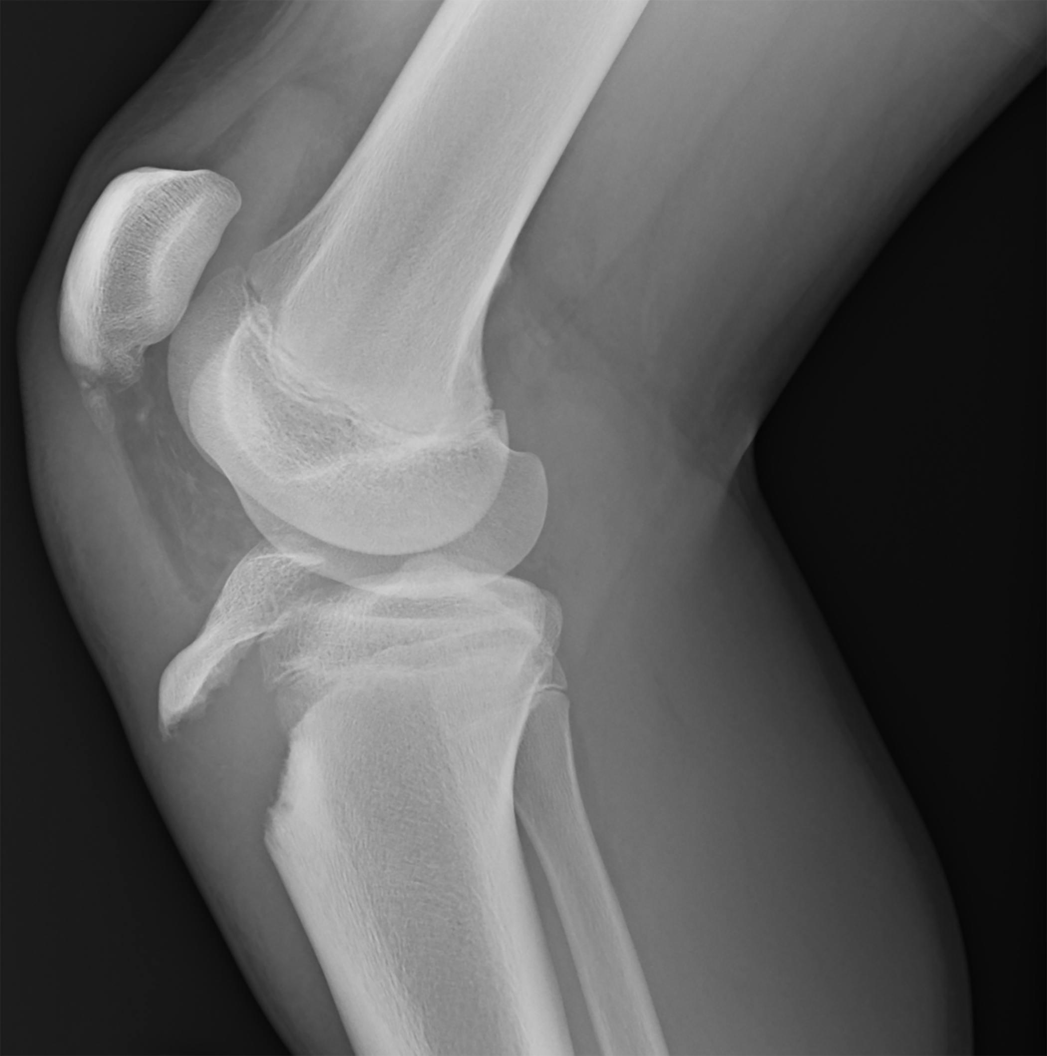 Radiograph of knee and tibia