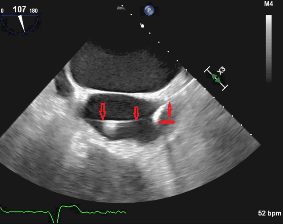MethicillinSusceptible Staphylococcus aureus Pacemaker Lead