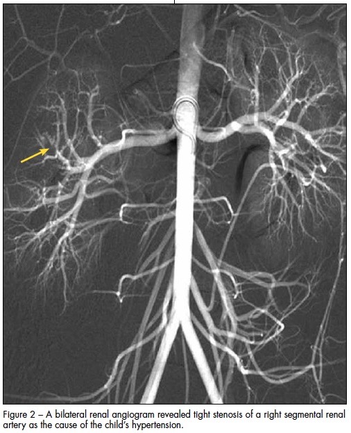 Renal angiogram